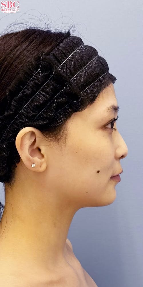 【女性・輪郭】Aquicell（アキーセル）脂肪吸引、根こそぎVASER脂肪吸引_before