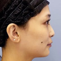 【女性・輪郭】Aquicell(アキーセル)脂肪吸引、根こそぎVASER脂肪吸引_before