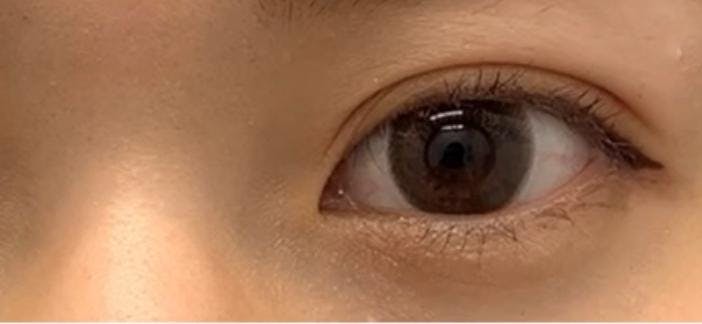 湘南美容クリニック 鹿児島院で二重埋没法:クイックコスメティーク・シングルNeoを受けたあやぱんさんの写真