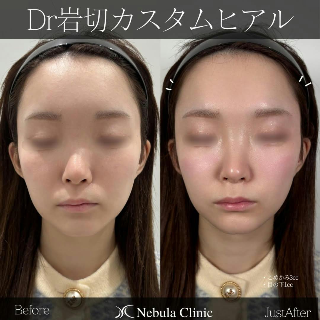 【女性・こめかみ・目の下】ヒアルロン酸注入(こめかみ・目の下)_before_aftar