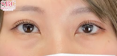 【女性・目元】クイックコスメティーク・ダブルNeo 下眼瞼下制（結膜切開法）_after