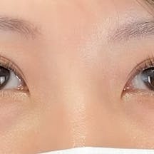 【女性・目元】クイックコスメティーク・ダブルNeo 下眼瞼下制(結膜切開法)_after