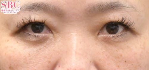 【女性・目元】目の下の切らないクマ・たるみ（ふくらみ）取り、ナチュラル脂肪注射コンデンスリッチ、ナチュラル脂肪注射ナノリッチ_aftar