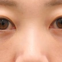 【30代女性・目元】目の下の切らないクマ・たるみ(ふくらみ)取り、ナチュラル脂肪注射コンデンスリッチ、ナチュラル脂肪注射ナノリッチ_after