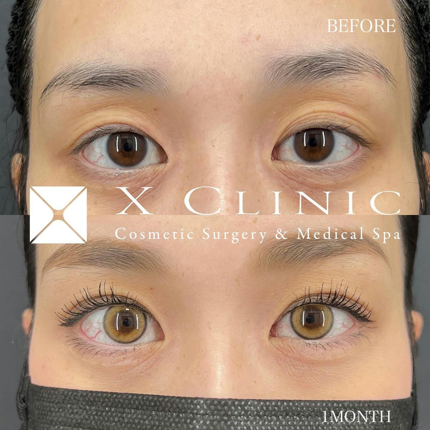 【女性・目元】エックスクロスダブル（二重埋没法）_before_aftar