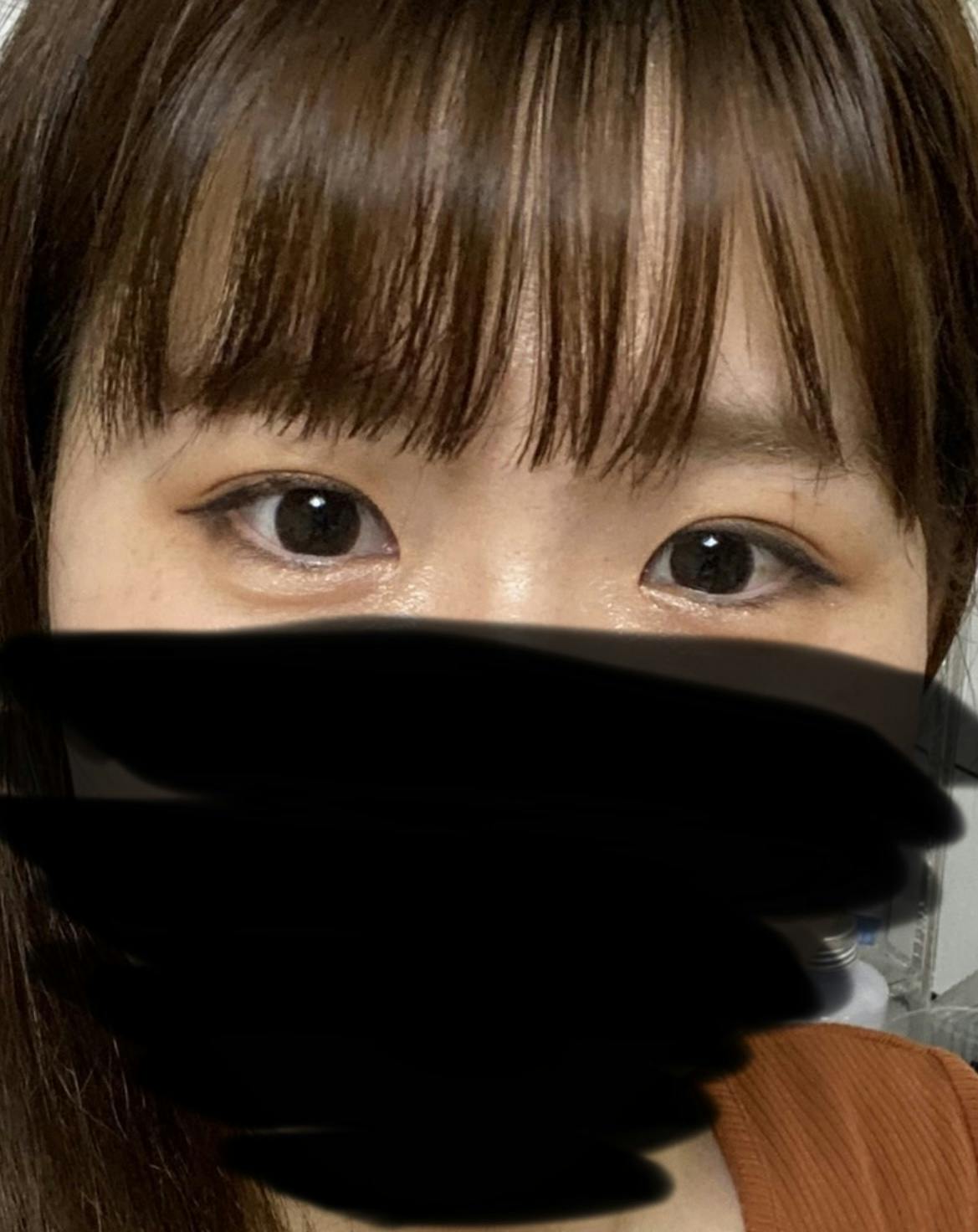 湘南美容クリニック  名古屋栄院で二重埋没を受けたみかさんの写真