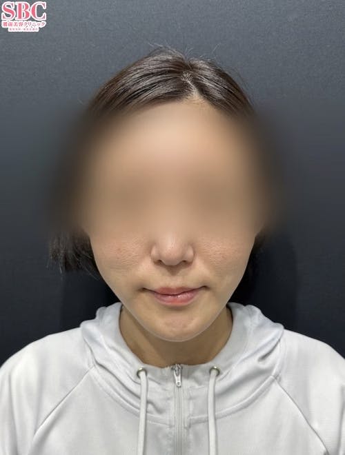 【30代女性・たるみ】シークレットリフト_after