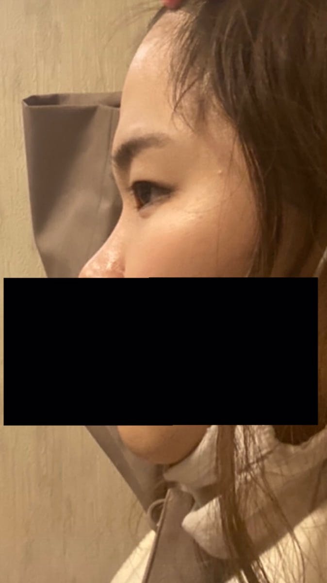 恵聖会クリニック 京橋院でヒアルロン酸注入（額・鼻筋）を受けた山藤さんの写真
