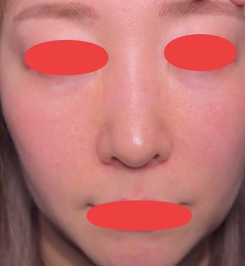 TCB東京中央美容外科 天王寺院で眉下リフト・スレッドリフト・メーラーファット除去・小顔脂肪吸引 :眉下切開 TCB小顔リフト メーラーファット除去 脂肪吸引を受けた山本さん家の美怜さんさんの写真