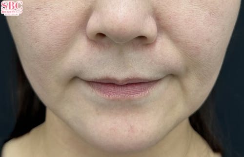 【30代女性・たるみ】ヒアルロン酸ジュビダームビスタ バイクロスシリーズ・VOV（ボブ）リフト・シークレットリフト_after