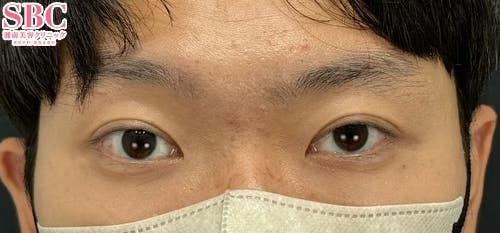 【20代男性・目元】線留めクロス二重術_aftar