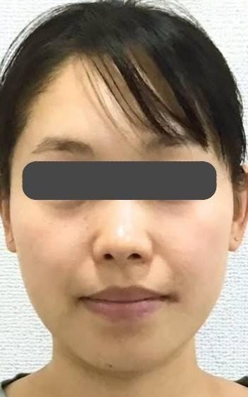 聖心美容クリニック 六本木院で輪郭注射：輪郭注射（頬・顎下）を受けたマイマイマイさんの写真