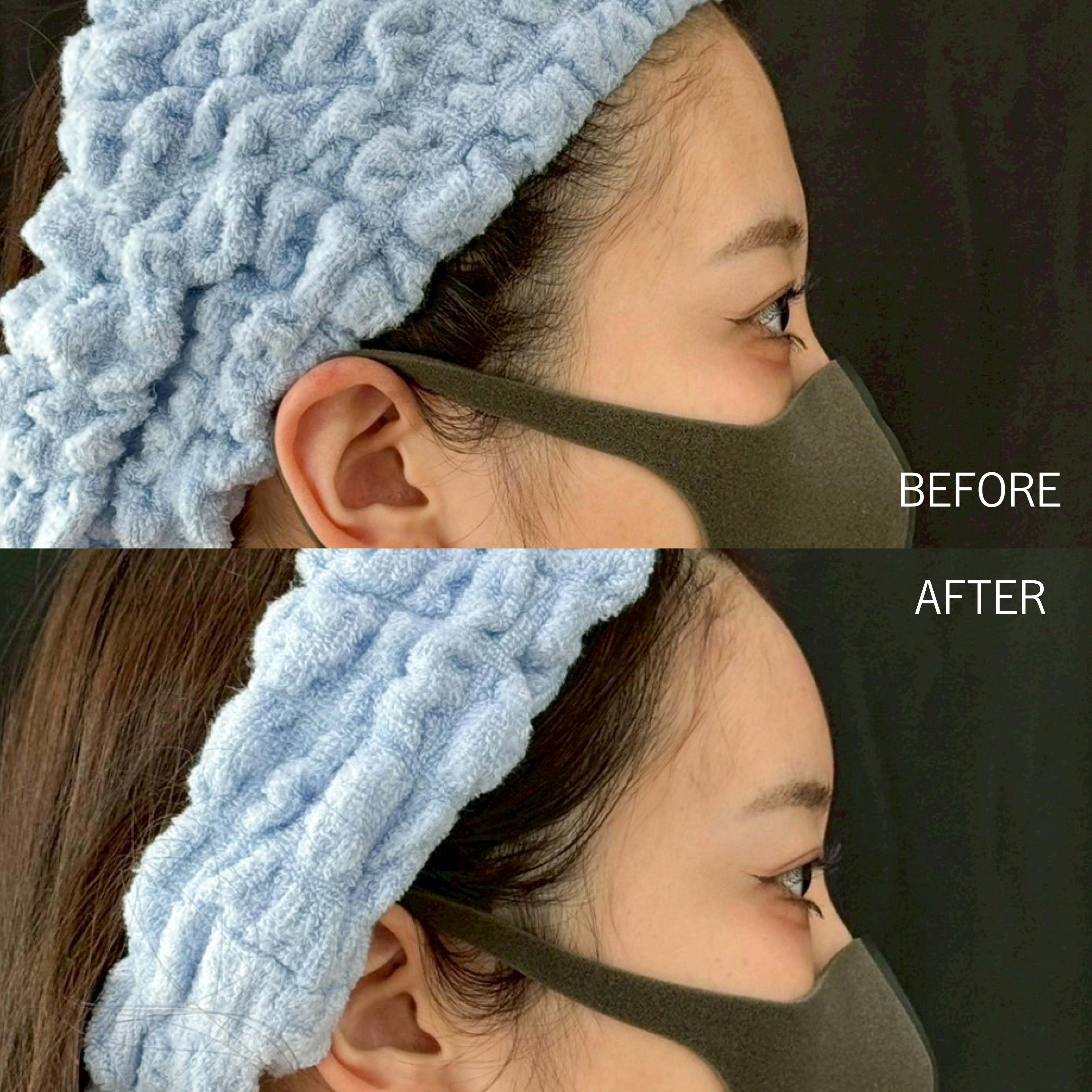 ヒアルロン酸_before_after