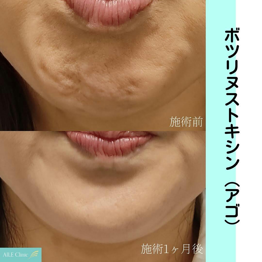 目の下のクマ・たるみ取り・口角ボトックス注射・ガミースマイル治療・ボトックス注射・顎のボトックス注射・ガミースマイルボトックス注射・目尻ボトックス注射 ・眉間ボトックス注射・目の下ボトックス注射・アーモンドアイボトックス注射・バニーライン・鼻根ボトックス ..., image size:1080x1080