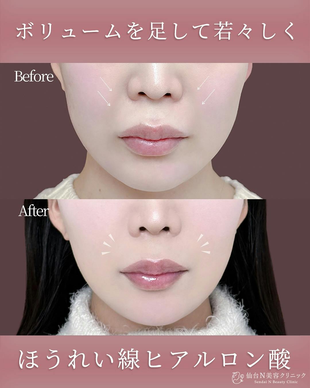 【女性・ほうれい線】ヒアルロン酸 ボリューマ_before_aftar