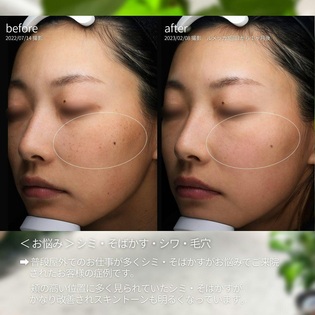 【女性・シミ】ルメッカ ドクターズコスメ _before_aftar