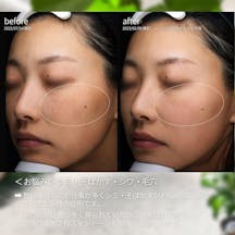 【女性・シミ】ルメッカ ドクターズコスメ _before_aftar