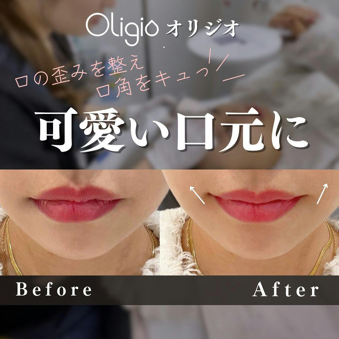 【女性・口元】Oligio(オリジオ):100shot_before_aftar