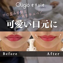 【女性・口元】Oligio(オリジオ):100shot_before_aftar