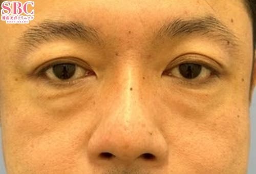 【男性・目元】ナチュラル脂肪注射コンデンスリッチ・目の下の切らないクマ・たるみ（ふくらみ）取り_before