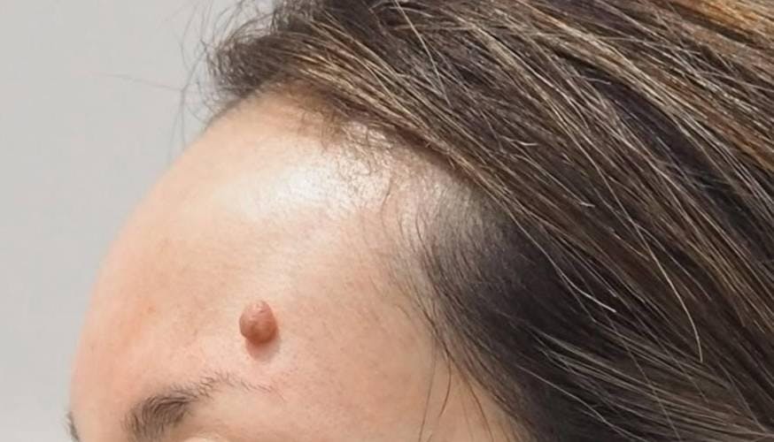 ジョウクリニック 銀座院でほくろ・イボ除去：炭酸ガスレーザー焼灼術（CO2レーザー）を受けたもーに。さんの写真