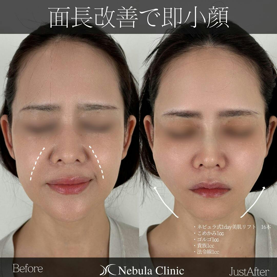 【女性・輪郭】糸リフト、ヒアルロン酸注入_before_aftar