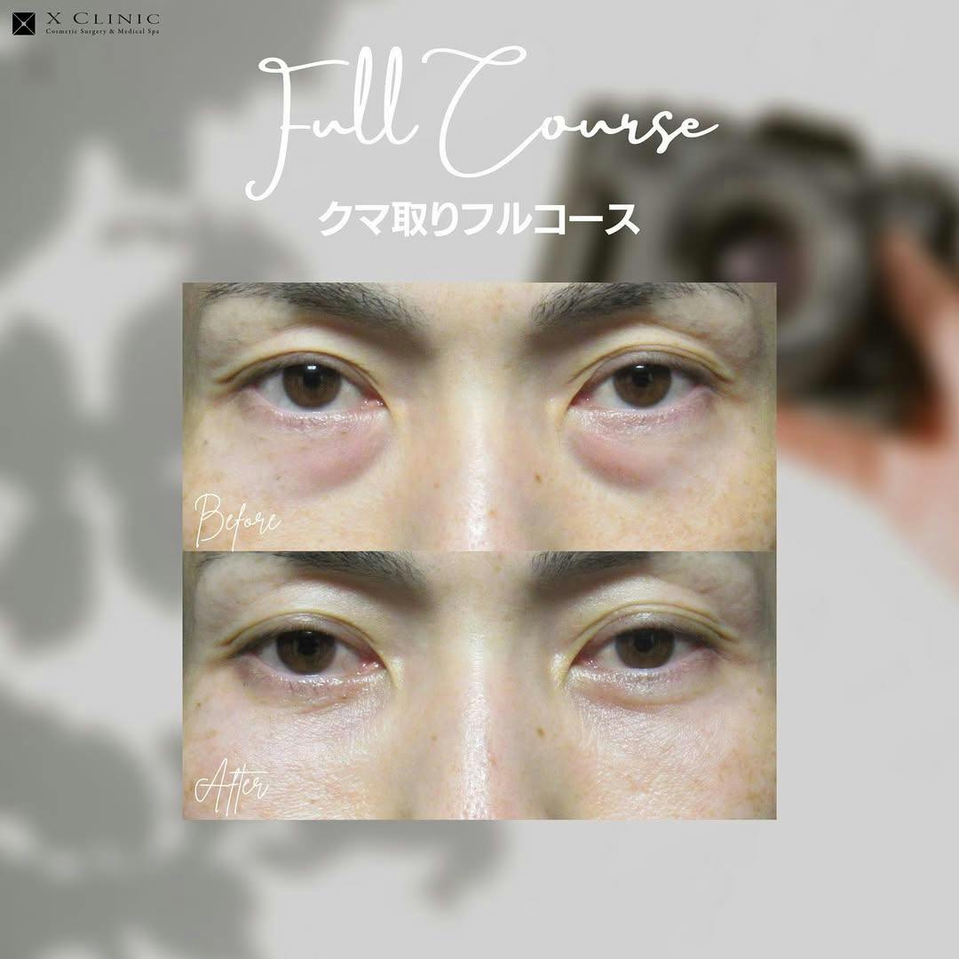 【クマ】クマ取りフルコース_before_aftar