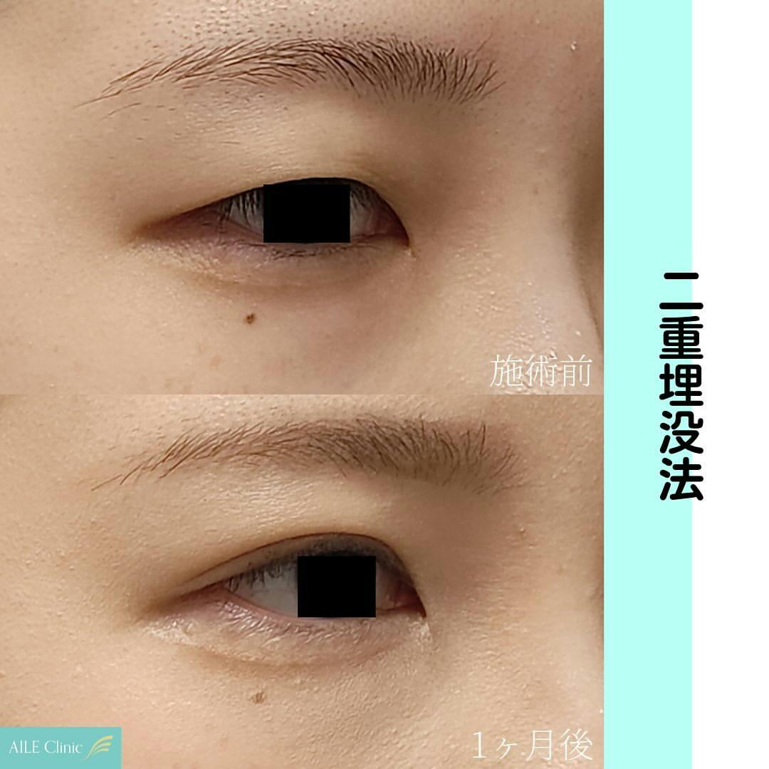 【女性・目元】二重埋没法_before_aftar