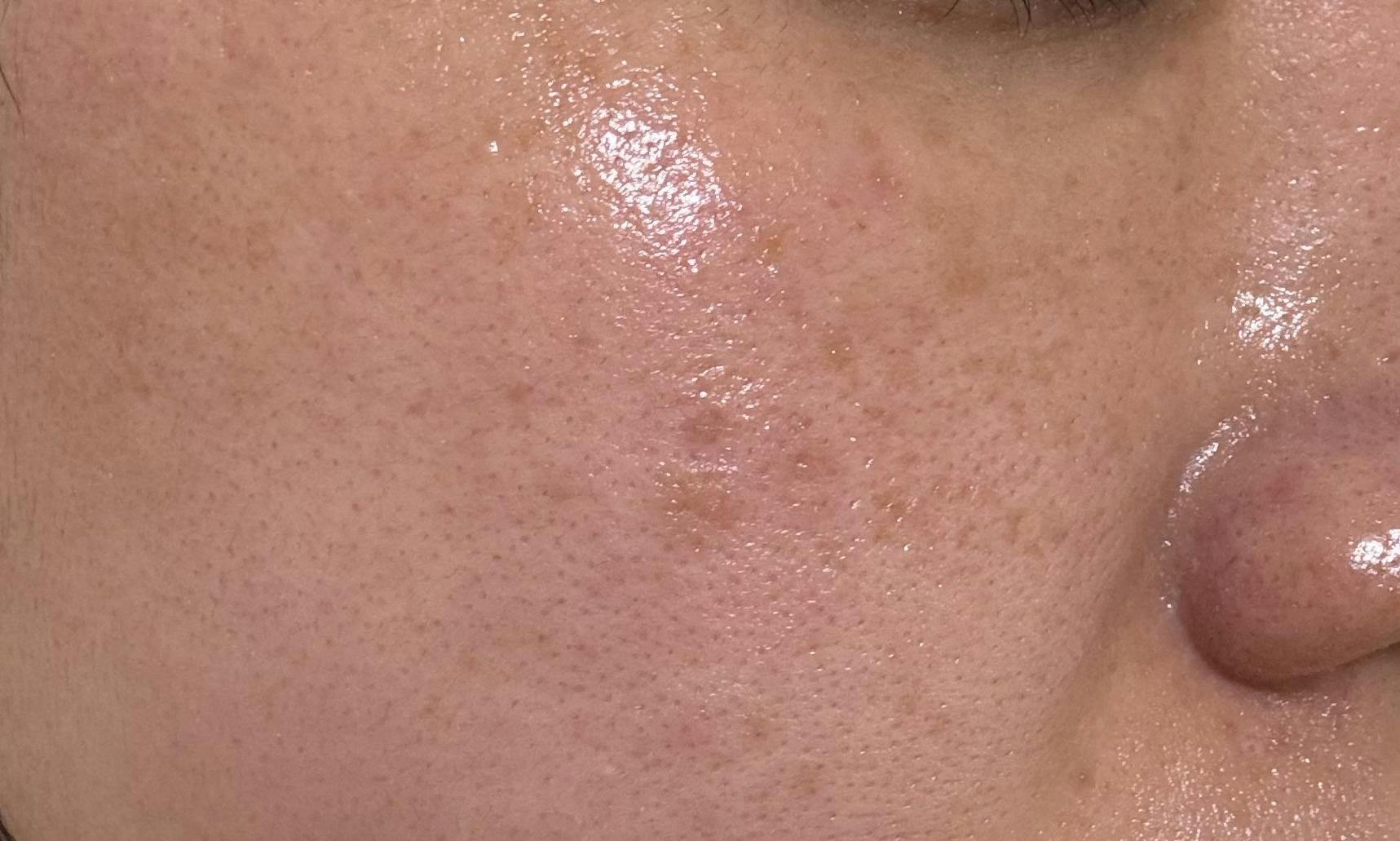 ルラ美容クリニック 池袋院でピコレーザーを受けたはるちゃんさんの写真