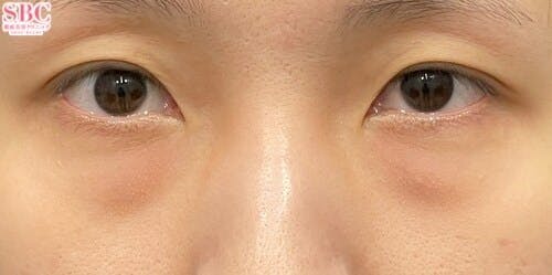 【女性・クマ】目の下の切らないクマ・たるみ（ふくらみ）取り ナチュラル脂肪注射コンデンスリッチ ナチュラル脂肪注射ナノリッチ_before