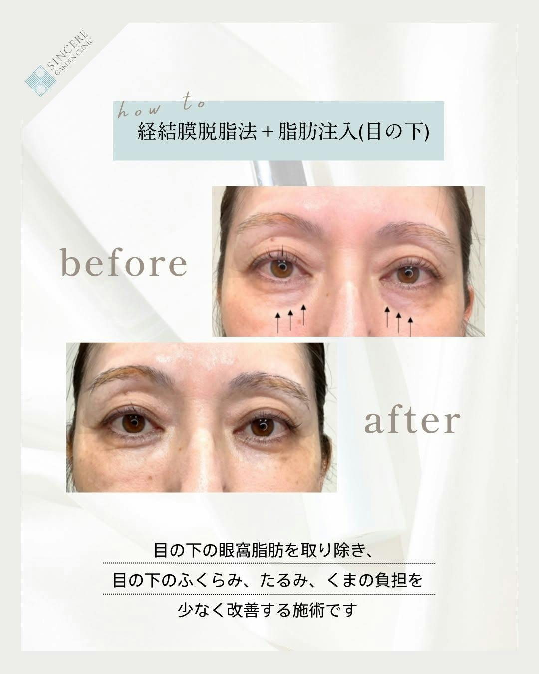 【女性・クマ】経結膜脱脂法_before_aftar