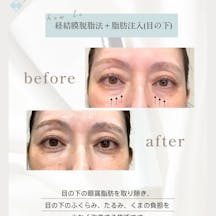 【女性・クマ】経結膜脱脂法_before_aftar