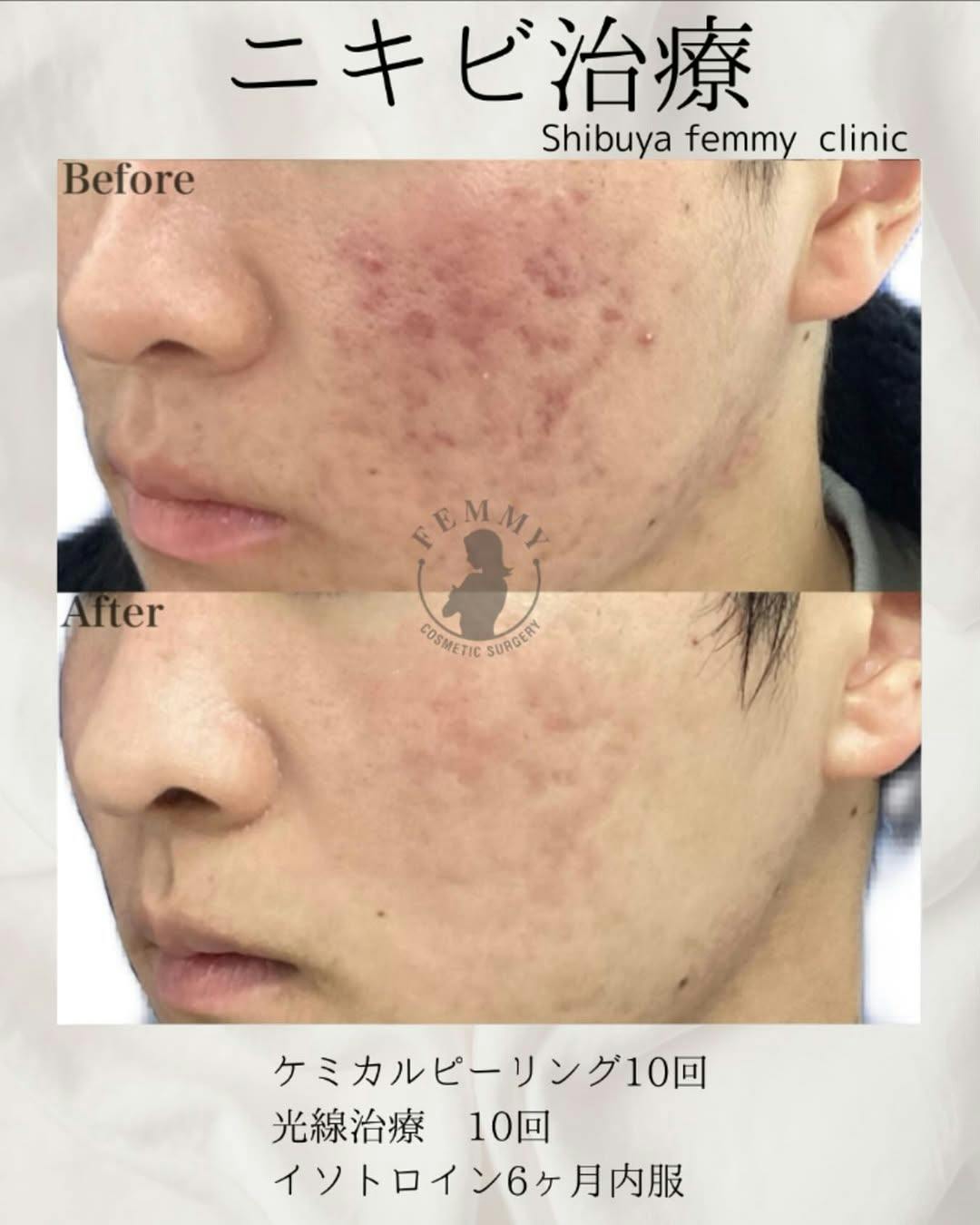【男性・ニキビ】ケミカルピーリング・光線療法・イソトロイン内服_before_aftar