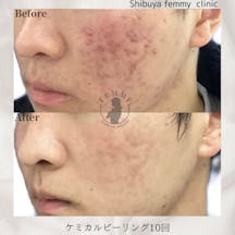 【男性・ニキビ】ケミカルピーリング・光線療法・イソトロイン内服_before_aftar