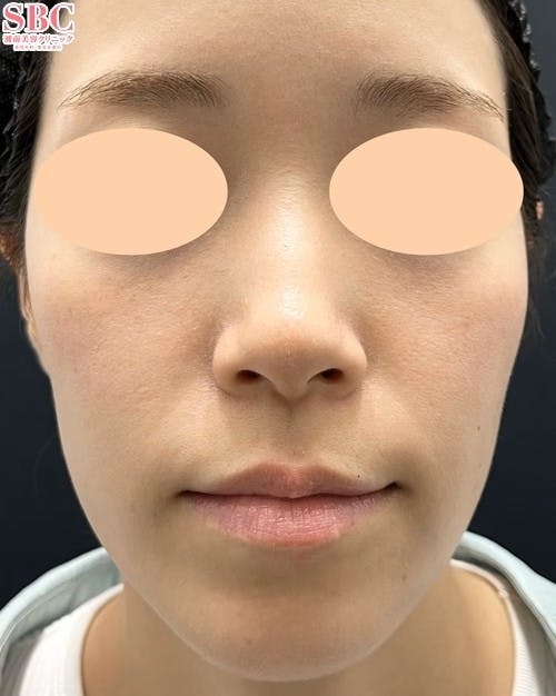 【30代女性・肌】プロファイロ ヒアルロン酸ジュビダームビスタ ボライトXC_after