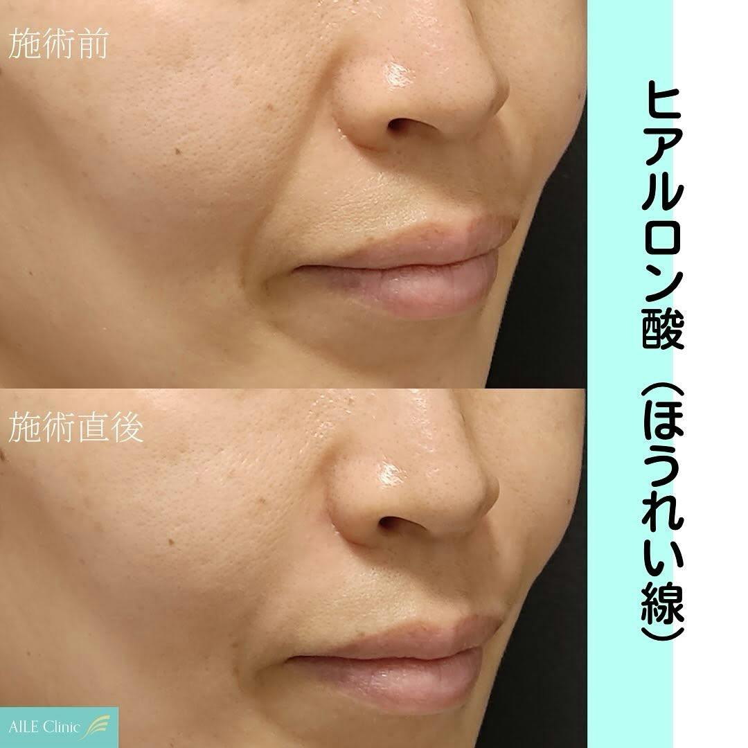 【女性・ほうれい線】ヒアルロン酸注入_before_aftar