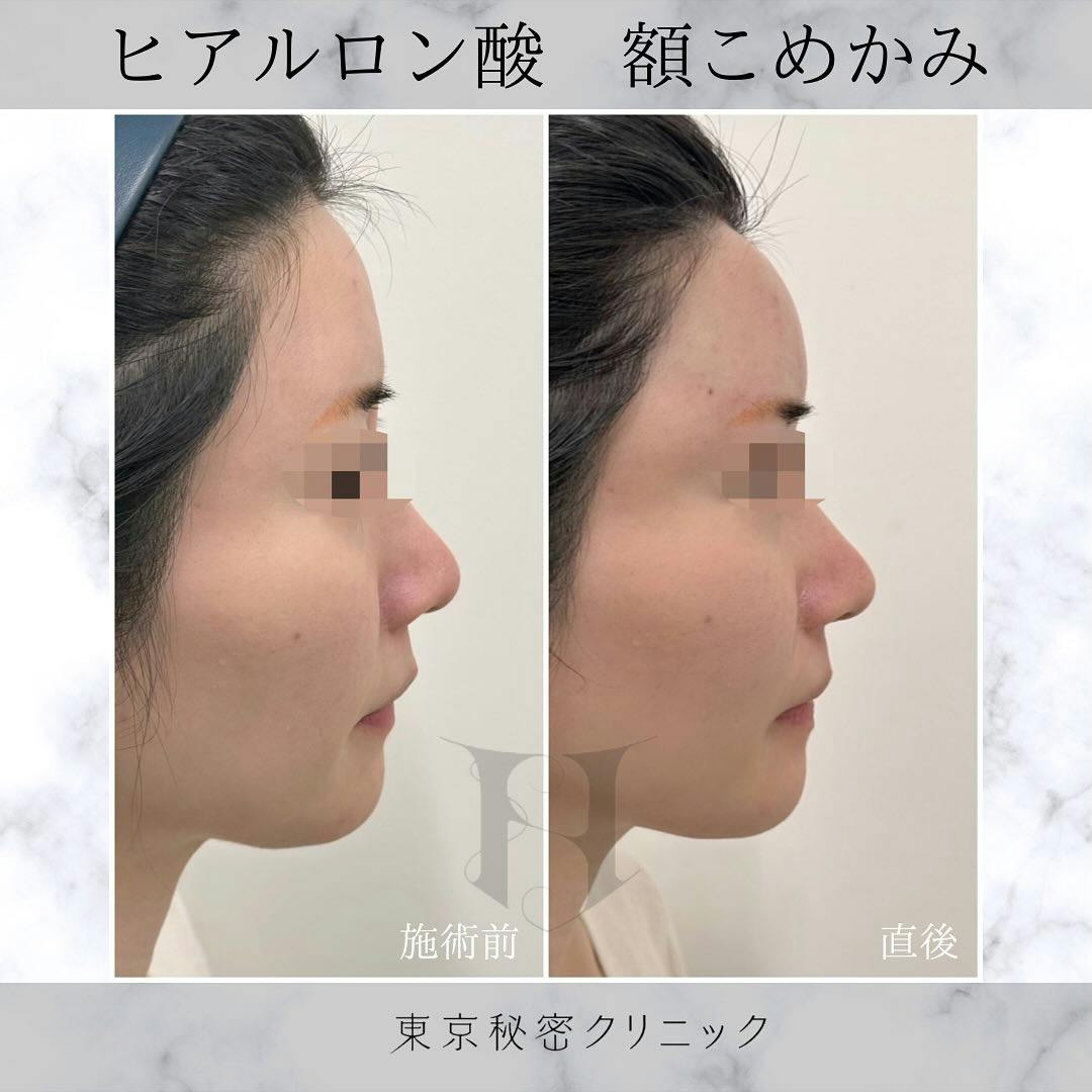 【女性・凹み】ヒアルロン酸（額・こめかみ）_before_aftar