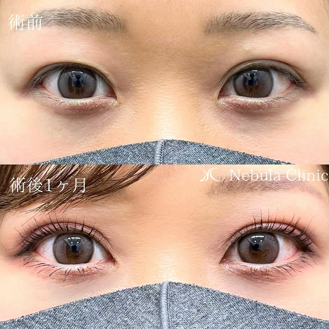 【女性・目元】二重埋没法_before_aftar