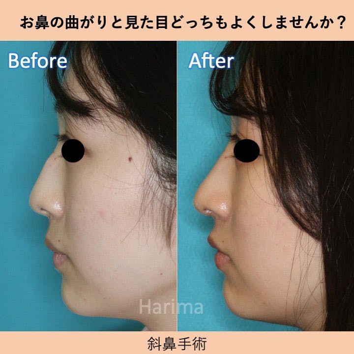 【女性・鼻】斜鼻修正・鼻中隔延長・肋軟骨移植・鼻尖形成・鷲鼻削り_before_aftar