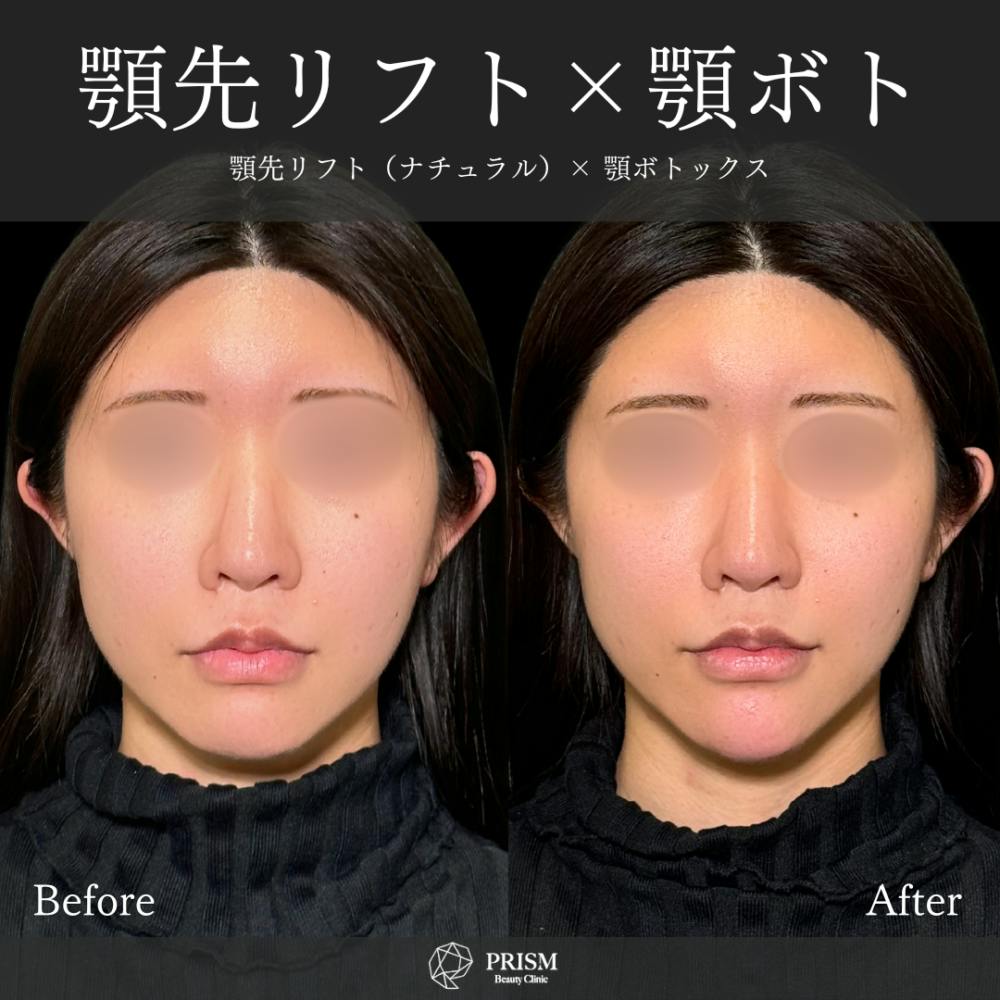【20代女性・顎】あご先リフト＋ボトックス（顎）_before_aftar