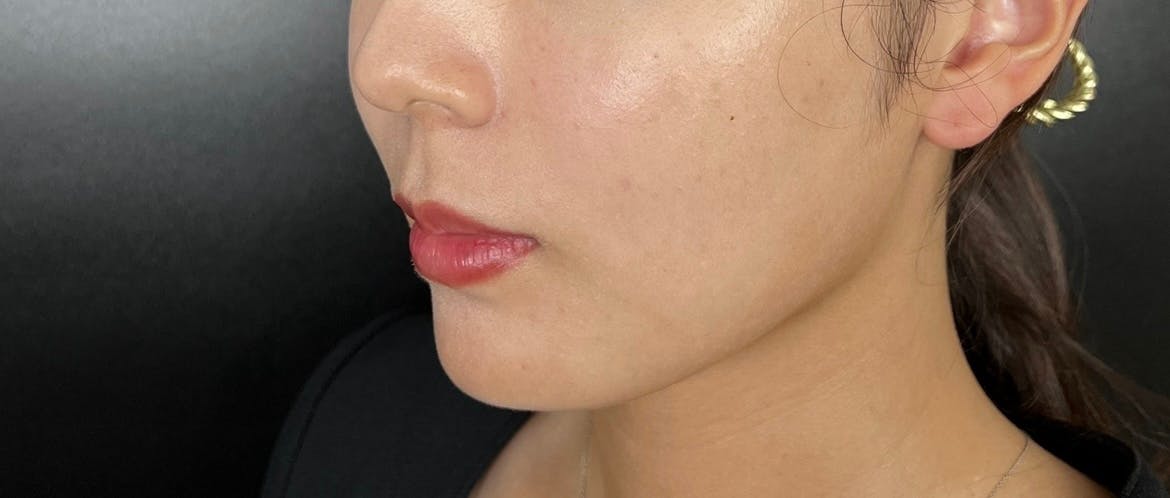 L’or Clinic Omotesando 札幌院（ロールクリニックオモテサンドウ）で顎下の脂肪吸引を受けたちょもさんの写真