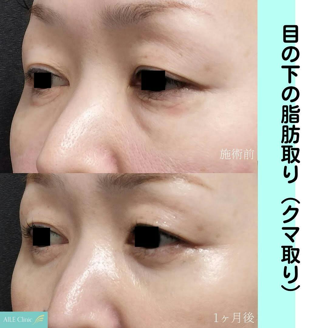 【女性・クマ】目の下の脂肪取り(クマ取り)_before_aftar