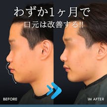 【20代男性・輪郭】上下顎セットバック+オトガイ形成_before_aftar