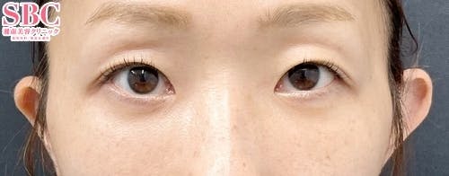 【30代女性・目元】目の下の切らないクマ・たるみ（ふくらみ）取り、ナチュラル脂肪注射ナノリッチ_after