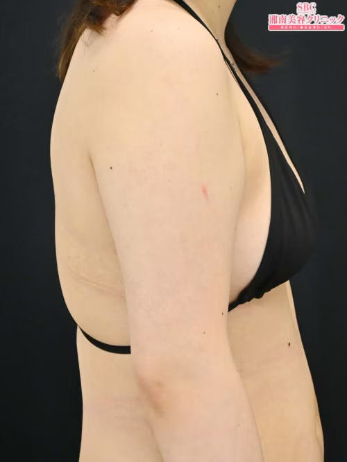 【20代女性・二の腕】クールスカルプティング(R)・ エリート（クルスカダブル） サクセンダ_after