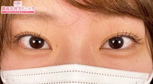 【女性・目元】線留めクロス二重術_after