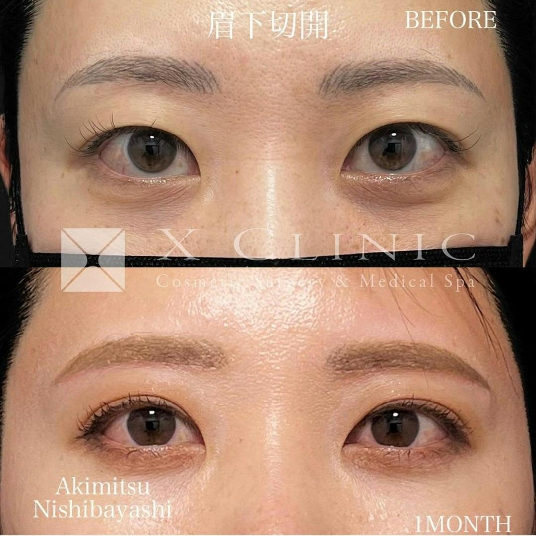 【女性・目元】眉下切開＋ルーフ切除_before_aftar