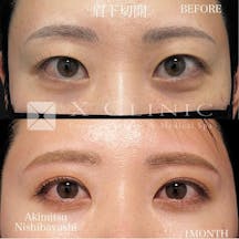 【女性・目元】眉下切開+ルーフ切除_before_aftar