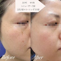 【女性・シミ】シミレーザー・フォトフェイシャル・レーザートーニング_before_aftar