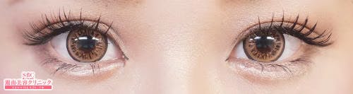 【女性・目元】クイックコスメティーク・シングルNeo、クイックコスメティーク・ダブルNeo、埋没法二重術クイックコスメティーク法_after